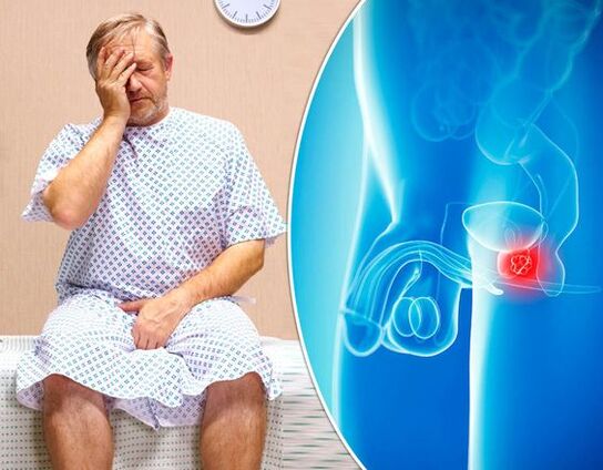 Sintomas de prostatite