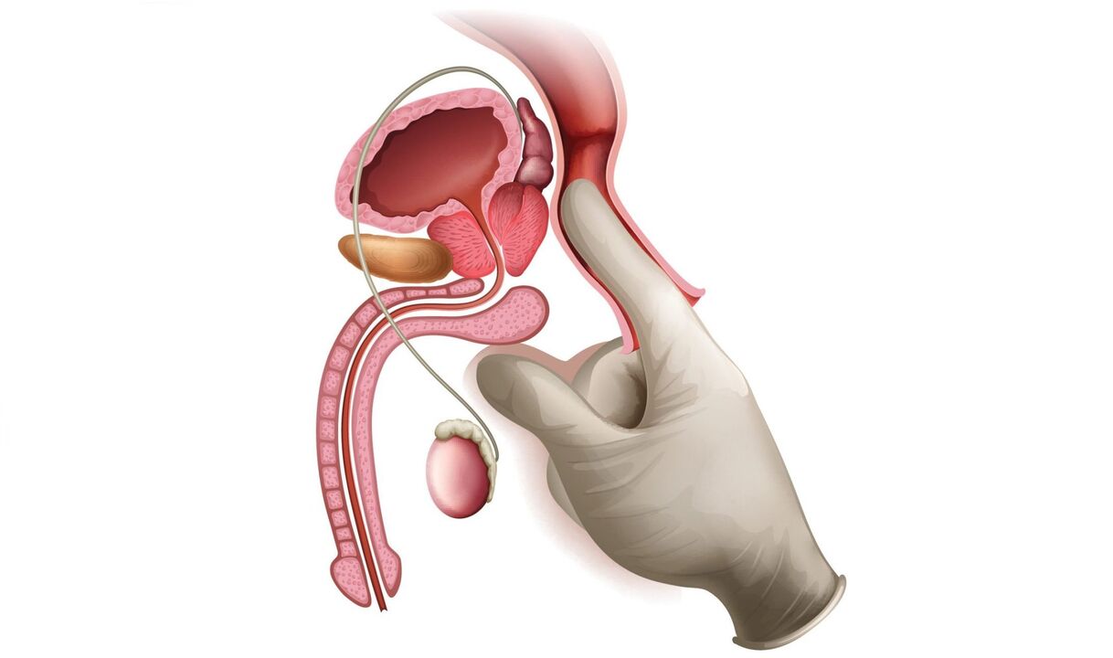 massagem de próstata para prostatite