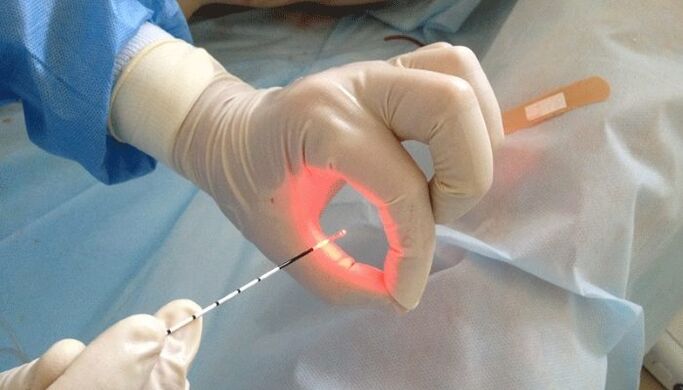 tratamento a laser para prostatite